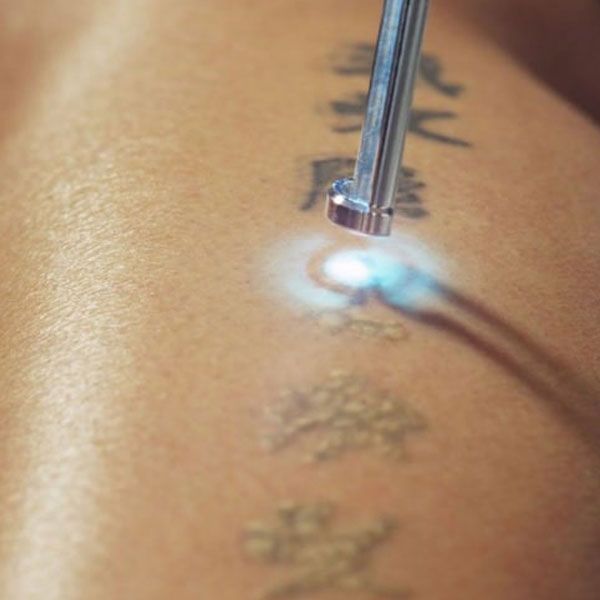 Laser Tattoo Removal