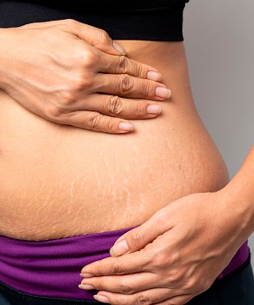 Stretch Marks