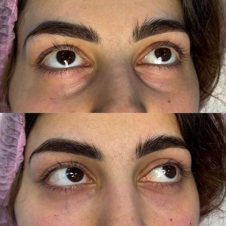 Dark Circle Treatment