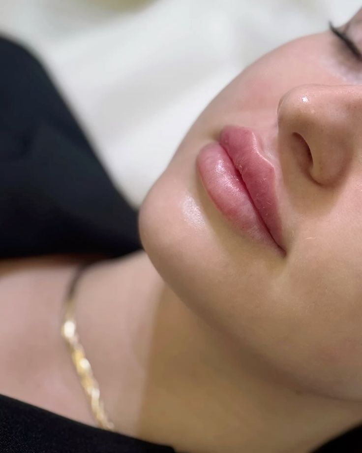 Hyaluronic Acid Filler (1 ml)