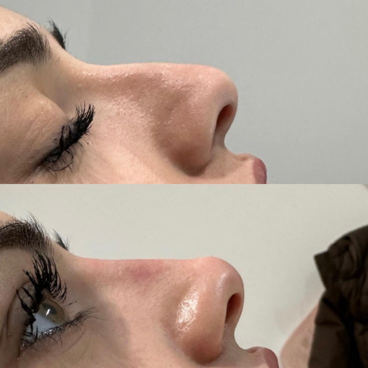 Non-Surgical Rhinoplasty