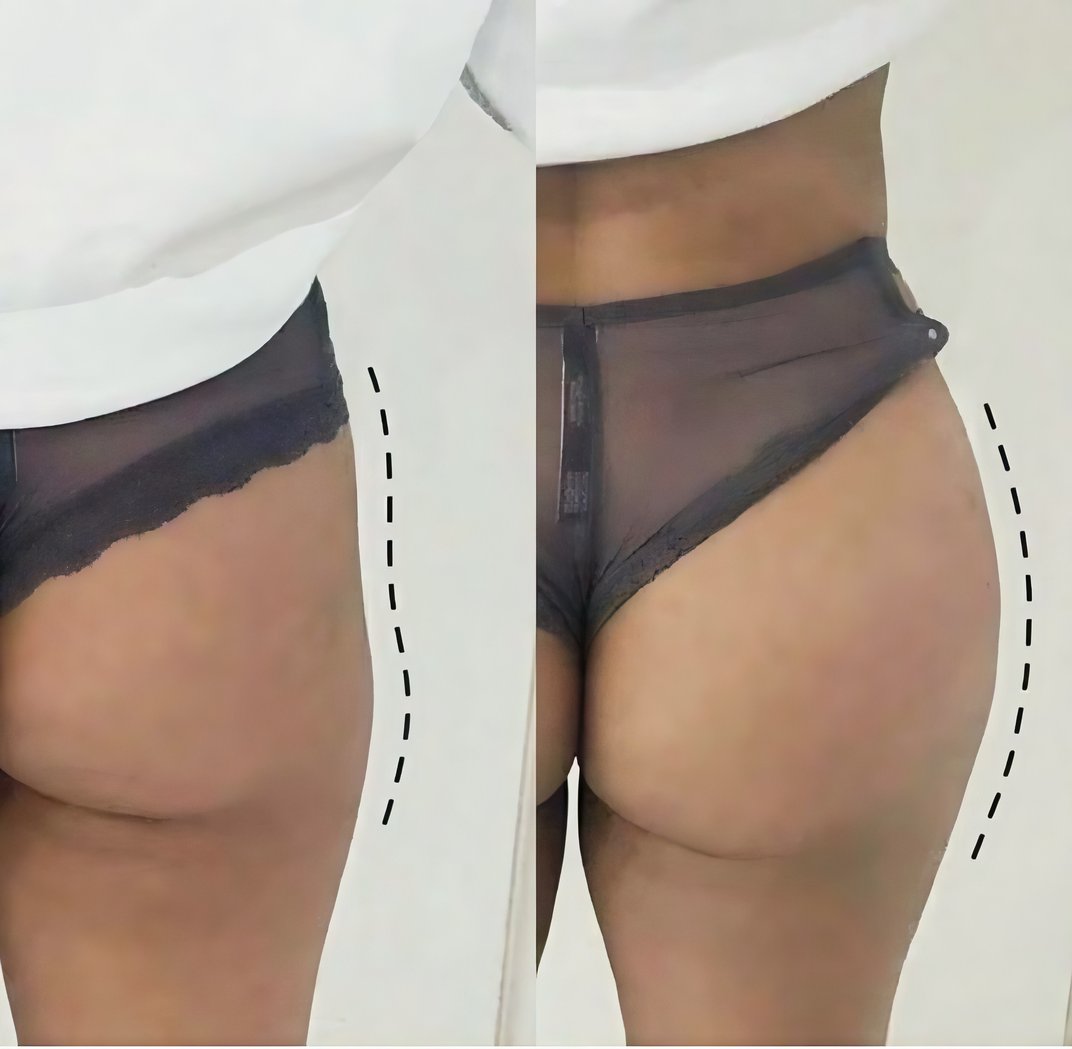 🍑 Comblement des fesses par filler : galber et sublimer sans chirurgie